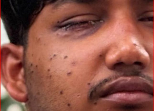 छात्र आंदोलन: राहुल गांधी ने युवाओं पर बलप्रयोग का मुद्दा उठाया, ‘पैलेट’ पीड़ित को पेश कर किए सवाल